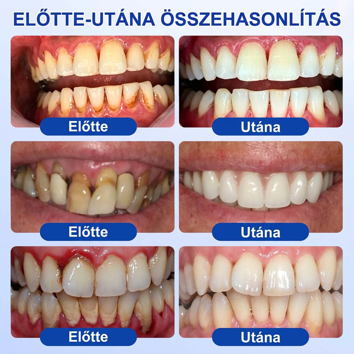 🦷🦷🦷PureShade® 🦷 GumRevive Ínyregeneráló Gél – Az egészségesebb ínyért és magabiztosabb mosolyért 👍
