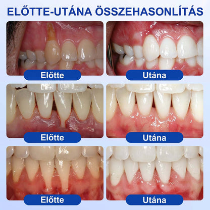 🦷🦷🦷PureShade® 🦷 GumRevive Ínyregeneráló Gél – Az egészségesebb ínyért és magabiztosabb mosolyért 👍