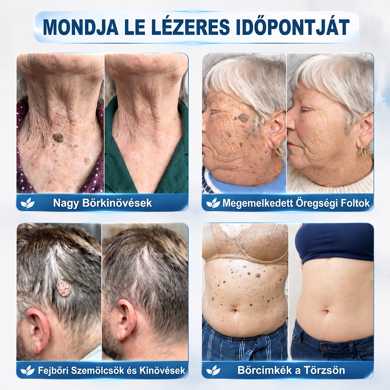 Hivatalos Márkabolt | 🚢 Hiskin® 7 napos Szemölcseltávolító Roll-on Ápoló Folyadék (Fájdalommentes rollerball technológia, hegek nélkül) 🐬 (副本)