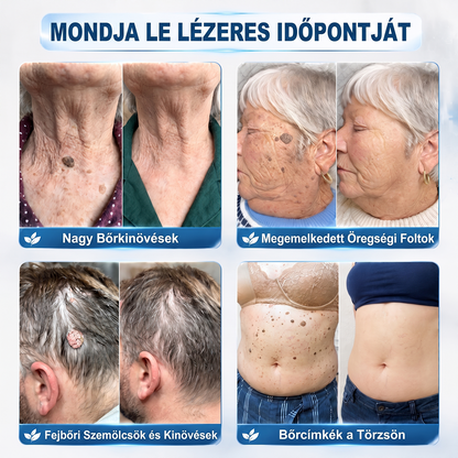 Hivatalos Márkabolt | 🚢 Hiskin® 7 napos Szemölcseltávolító Roll-on Ápoló Folyadék (Fájdalommentes rollerball technológia, hegek nélkül) 🐬 (副本)