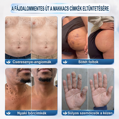 Hivatalos Márkabolt | 🚢 Hiskin® 7 napos Szemölcseltávolító Roll-on Ápoló Folyadék (Fájdalommentes rollerball technológia, hegek nélkül) 🐬 (副本)