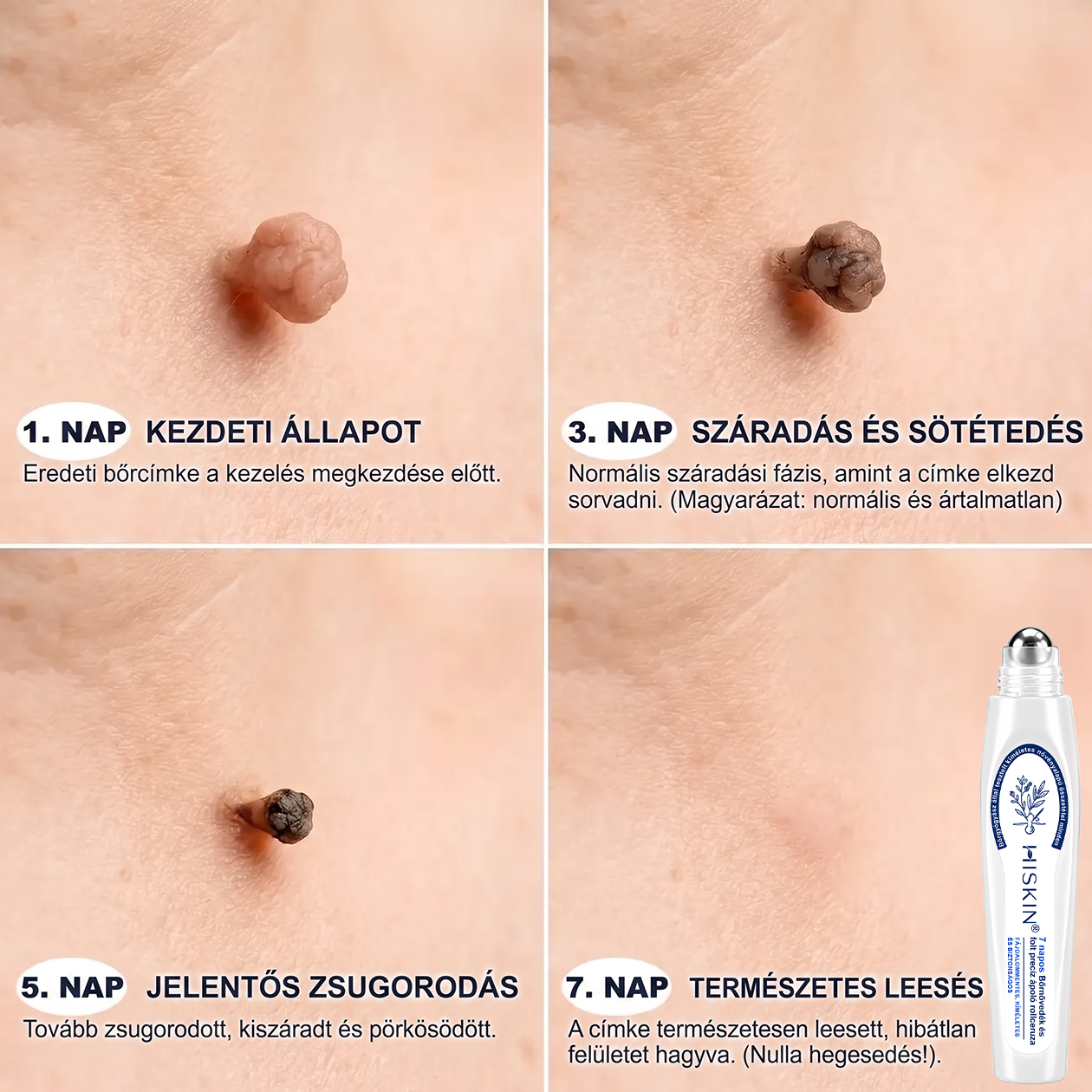 Hivatalos Márkabolt | 🚢 Hiskin® 7 napos Szemölcseltávolító Roll-on Ápoló Folyadék (Fájdalommentes rollerball technológia, hegek nélkül) 🐬 (副本)