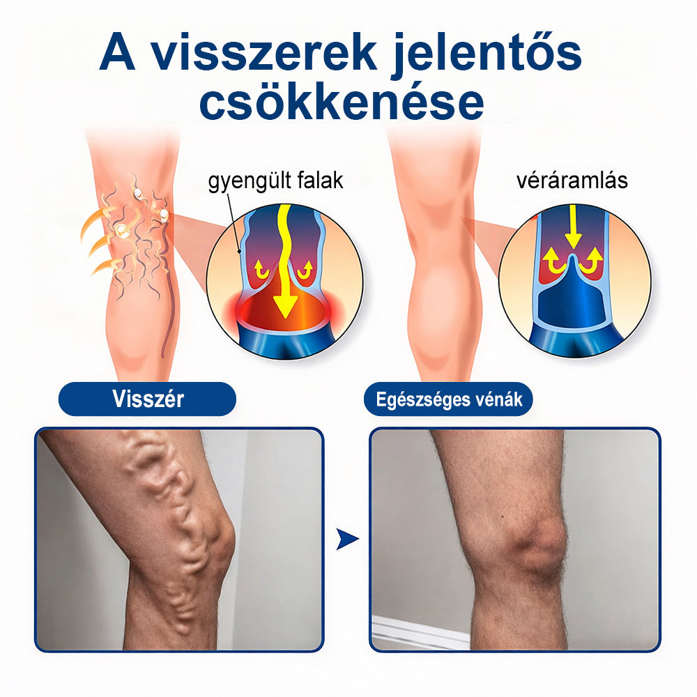 🌧️ FFBSI® Visszérápoló Mikrotűs Gondozó Tapasz ⚡ Azonnali Megkönnyebbülés, Hosszú Távú Eredmények